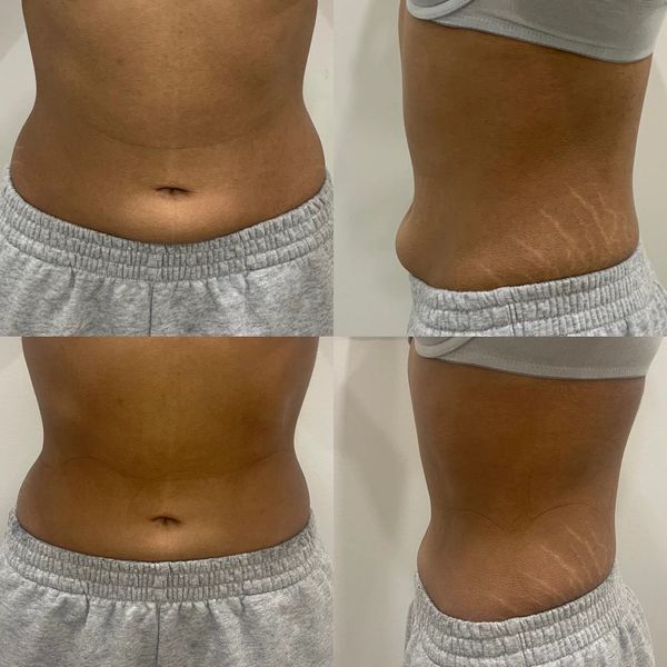 before and after body sculpting jadore laser and spa white rock
