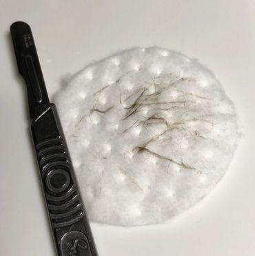 dead skin cells on cotton pad from dermaplaning and derma blade at the spa in white rock