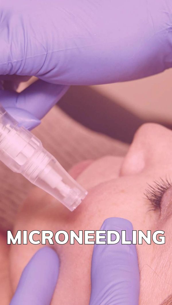 Microneedling Treatment White Rock