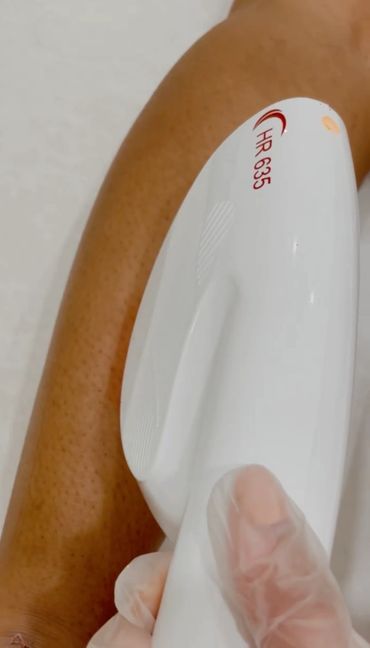 underarm laser hair removal for woman in surrey. Armpits receiving painless laser treatment