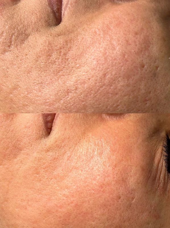 microneedling before & after one treatment enlarged pores at jadore laser & spa white rock surrey