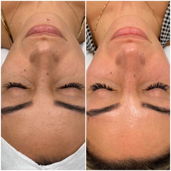 microneedling before and after 1 treatment bright skin results jadore laser & spa white rock surrey