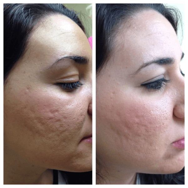Face microneedling before & after woman enlarged pores and acne scar. jadore laser & spa white rock