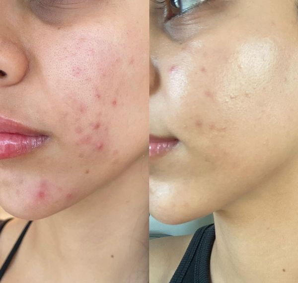 before and after facial jadore laser and spa white rock