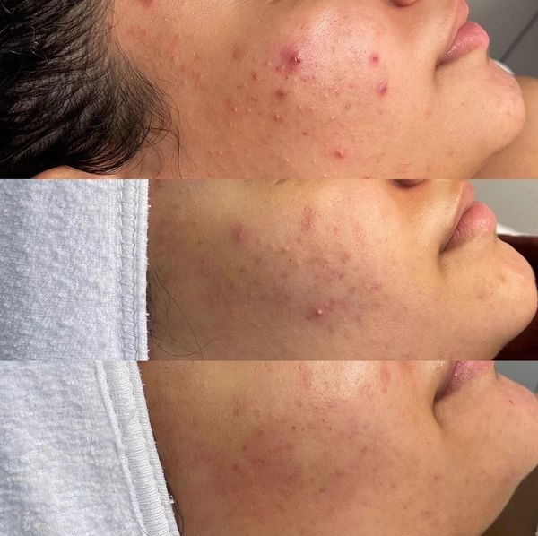 before and after acne facial jadore laser and spa white rock