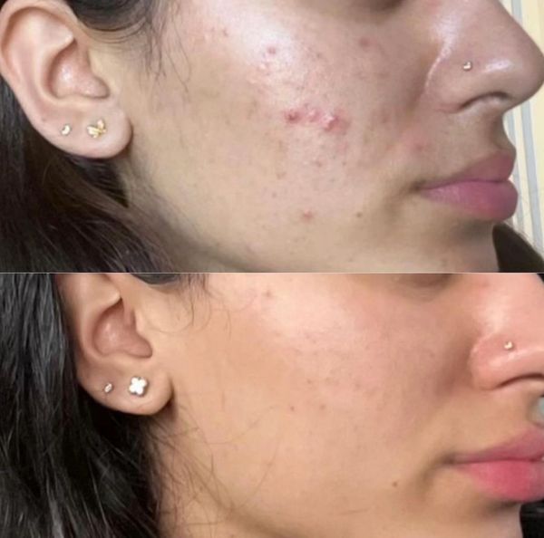 before and after acne facial jadore laser and spa white rock