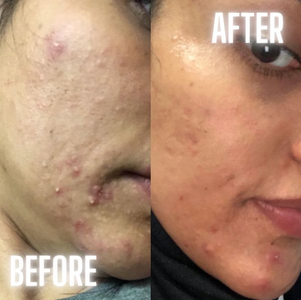 before and after facial jadore laser and spa white rock
