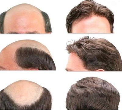 Before and after hair restoration comparison.