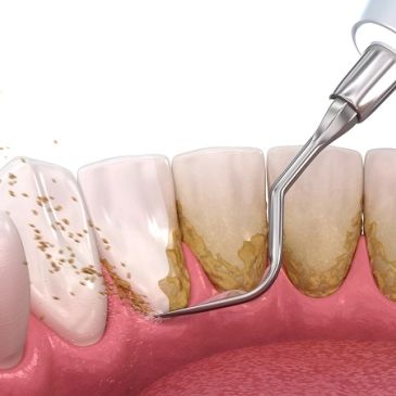 Dental scaling removing plaque and tartar from teeth.