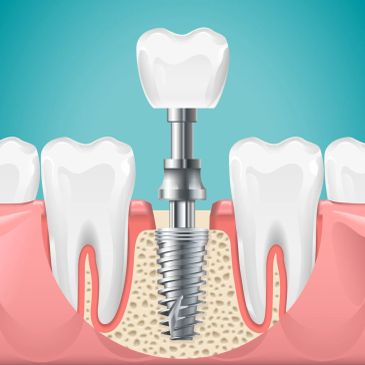 Illustration of a dental implant procedure.