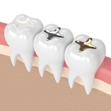 Three molars with different metal dental fillings.