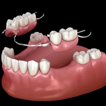 3D illustration of partial dentures fitting into a lower jaw.