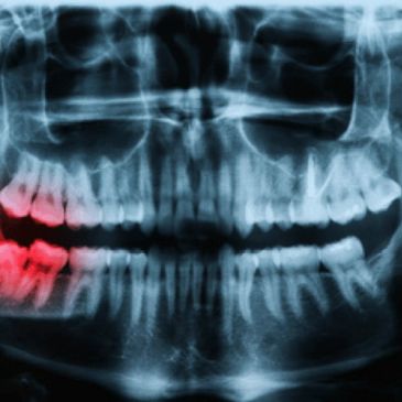 Dental x-ray showing impacted wisdom teeth highlighted in red.