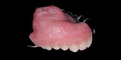 Obturator with metal clasps and pink acrylic base.