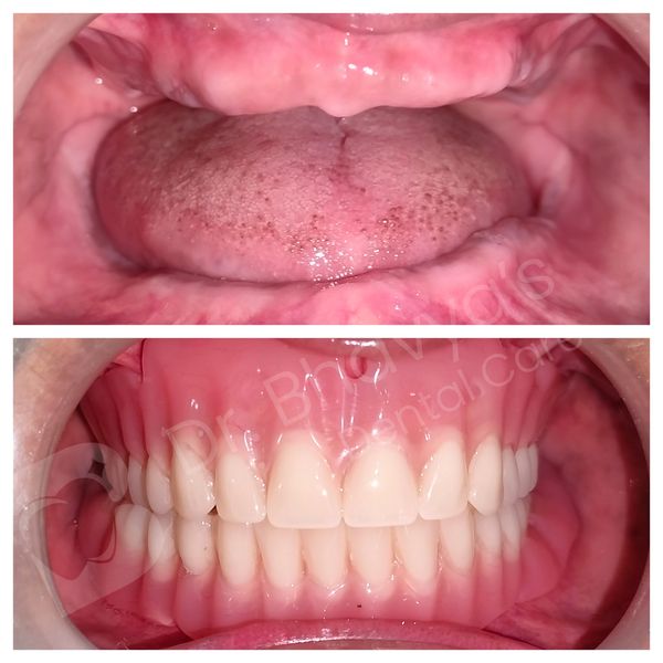 ACRYLIC COMPLETE DENTURE