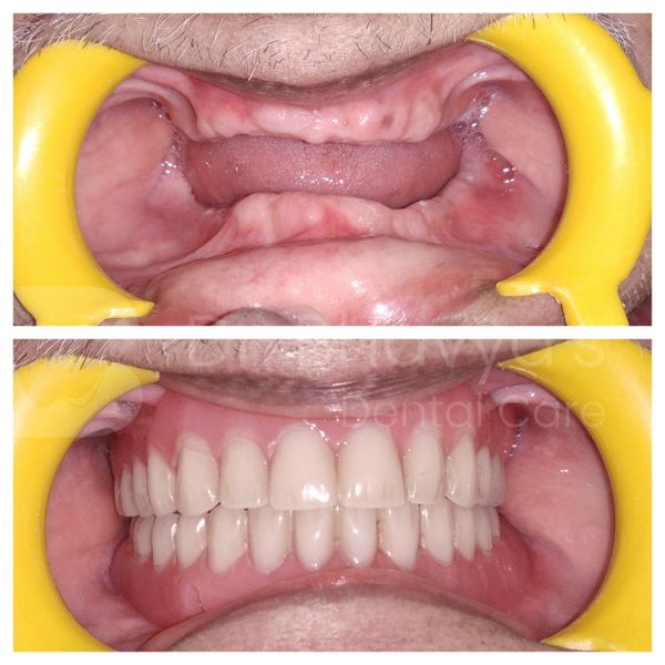 DENTAL SERVICES FOR ELDERLY - COMPLETE DENTURES