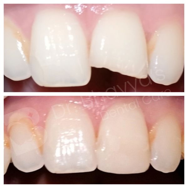 TOOTH COLORED COMPOSITE FILLING