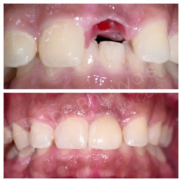 DENTAL IMPLANT  WITH ZIRCONIA CROWN FOR MISSING FRONT TOOTH