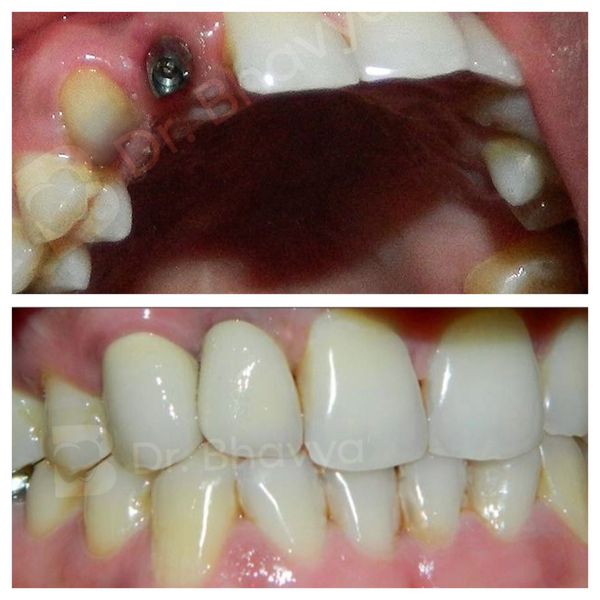 SINGLE TOOTH IMPLANT WITH METAL CERAMIC CROWN