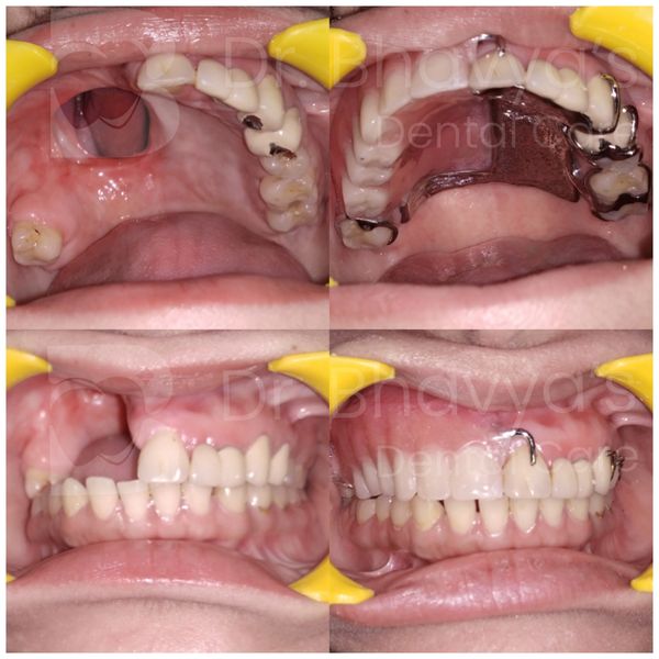 DEFECT IN UPPER JAW POST TUMOR REMOVAL RESTORED WITH OBTURATOR