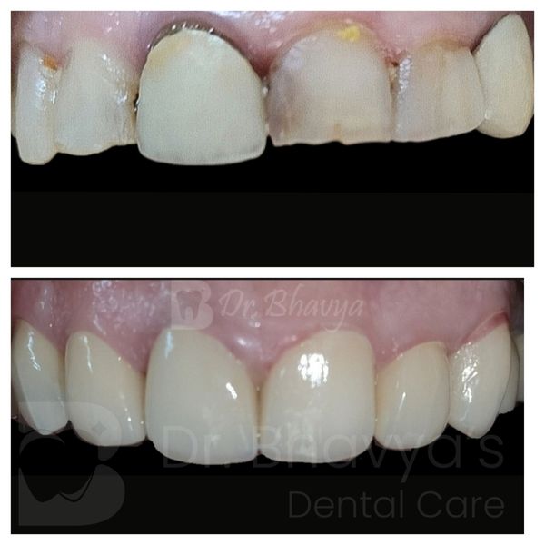 SMILE DESIGNING WITH FULL CERAMIC CROWNS