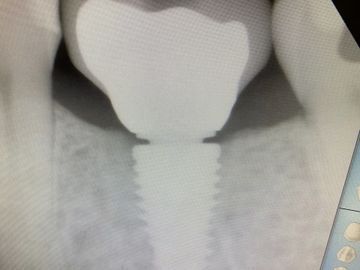 picking a 1.5 margin abutment will get the abutment/crown interface away from the bone.
