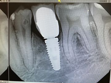 filled entire space with material.  NOT NECESSARY.  Use a 1.5 or 2.5 height margin on abutment
