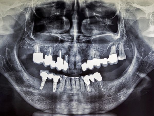 CBCT Scan. In depth scan of your gums, teeth, jaws, TMJ, bones, sinuses