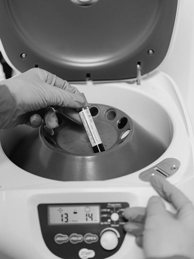 PRP behandeling voor haarstimulatie en verjonging van gezicht met eigen bloed. Vampire facelift