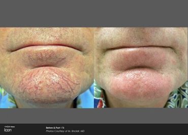 Icon IPL Photofacial results. Treatment available at Buckeye Beauty Bar in Columbus, Ohio.