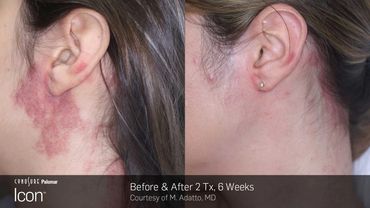 Icon IPL Photofacial results. Treatment available at Buckeye Beauty Bar in Columbus, Ohio.
