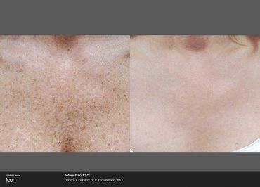 Icon IPL Photofacial results. Treatment available at Buckeye Beauty Bar in Columbus, Ohio.