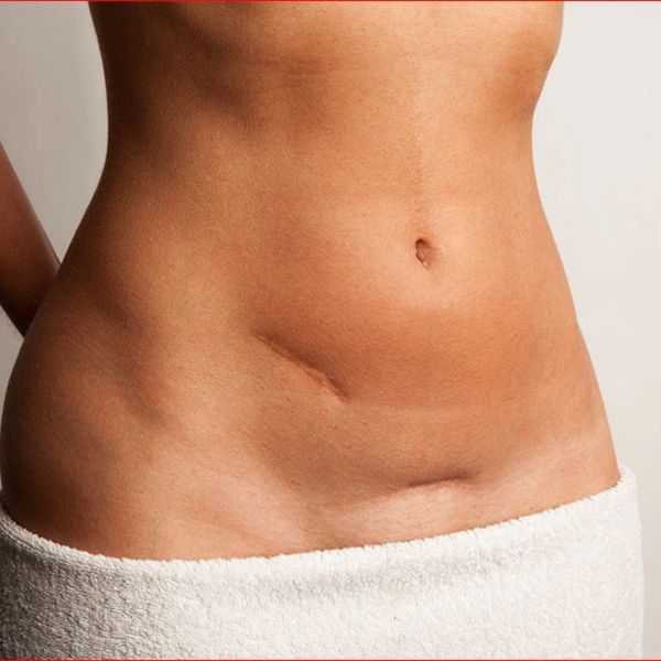 Scarring on the stomach area after surgery