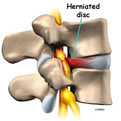 Illustration of a herniated disc compressing the exiting nerve root