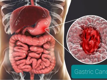 Stomach specialist near me
Stomach cancer specialist in Mumbai