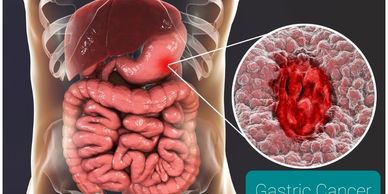 Stomach specialist Dr Nitin Jain for gastric cancer
