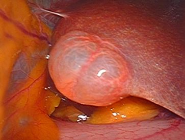 Liver cysts and tumours specialist surgeon in Mumbai