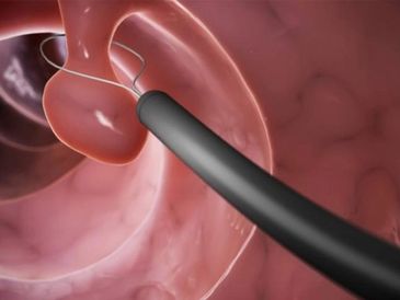 colon polyp removal
Colonoscopic polypectomy