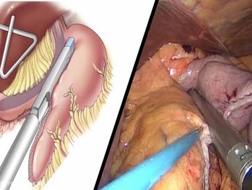 weight loss surgery in mumbai
bariatric surgeon in mumbai