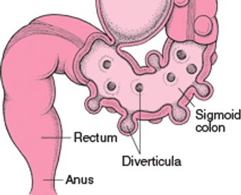 diverticulitis treatment
colorectal surgeon in mumbai