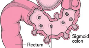 colon diverticulits
diverticulitis treatment in Mumbai
