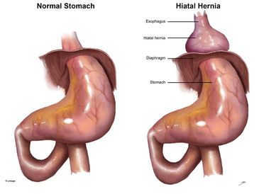 Laparoscopic hiatal hernia surgery
Hiatal hernia treatment in Mumbai