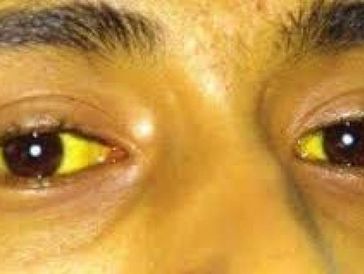 Gallstone jaundice treatment
CBD stones ERCP