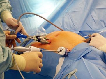 laparoscopic gallbladder removal
