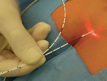 piles laser treatment near me