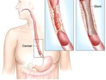 Esophagus cancer oncologist 
Dysphagia causes