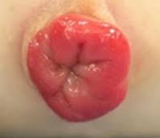 rectal prolapse surgery