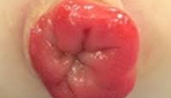 rectal prolapse symptoms
Rectal prolapse surgery
Piles operation near me