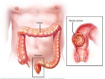 colon cancer specialist  in mumbai
Colorectal cancer surgeon
