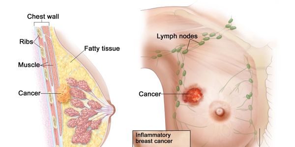 A diagram of Stage 3 breast cancer